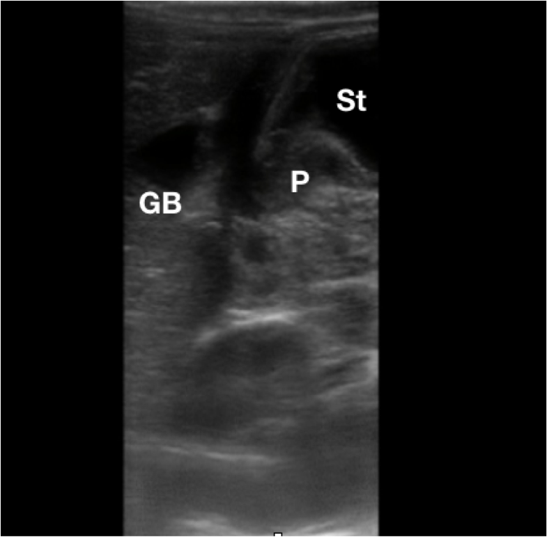 Figure 2. Sonographic anatomy of the pylorus (P) in relation to the gallbladder (GB) and stomach (St).png