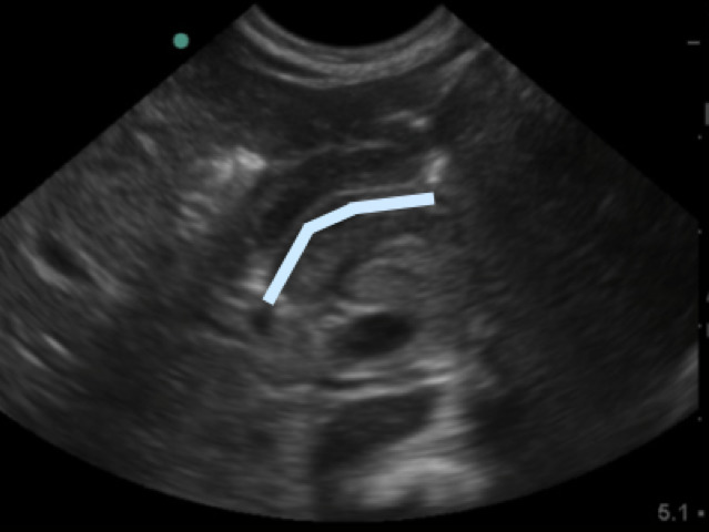 Figure 4b. Highlighted pyloric channel made up of gastric mucosa.jpg