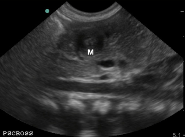 Figure 5. Pylorus in short axis_ transverse view, the “target sign” (M_ pylorus muscle).jpg