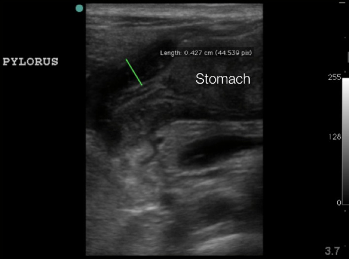 Figure 6. Hypertrophied pyloric muscle in long axis measuring 4.3mm.jpg