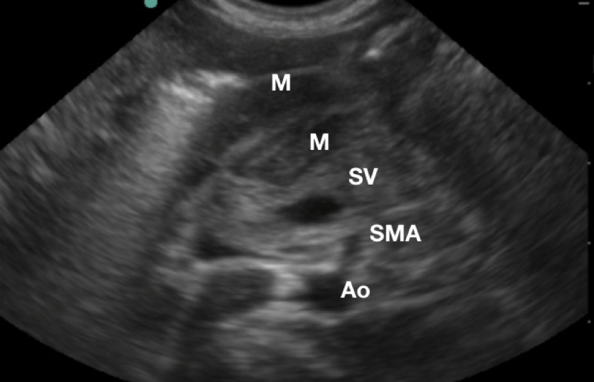 Figure 3 Sonographic anatomy of the pyloric muscle .JPG