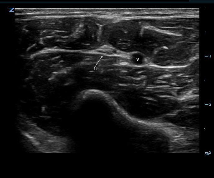 Figure 3. Nerve adjacent to a vessel.jpeg