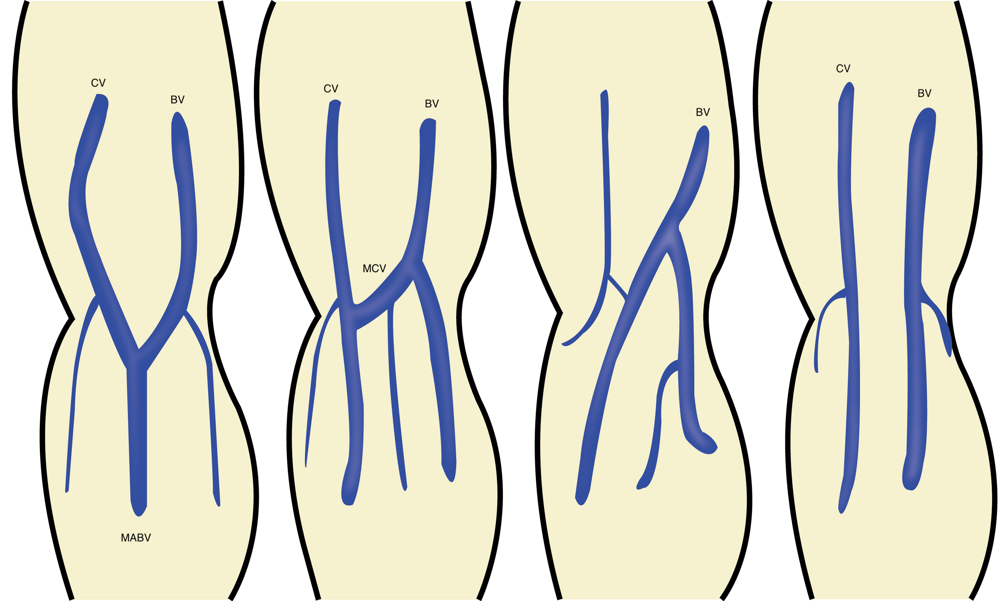 Ill 1 Variations in upper ext veins.png