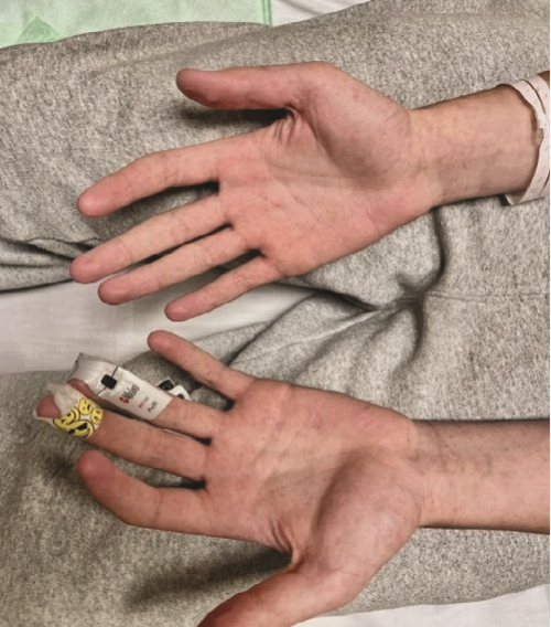 Figure 1 Dengue fever figure 1