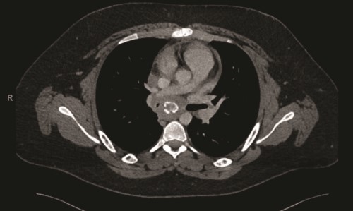 Figure 2 Figure 2.pdf.jpg Fibrosing mediasta