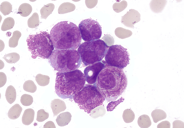 AcutePromLeuk-Jan2025 (3).png