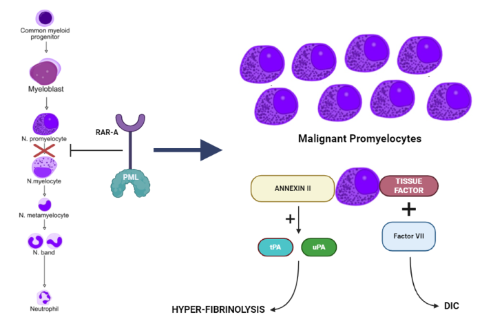 AcutePromLeuk-Jan2025 (4).png