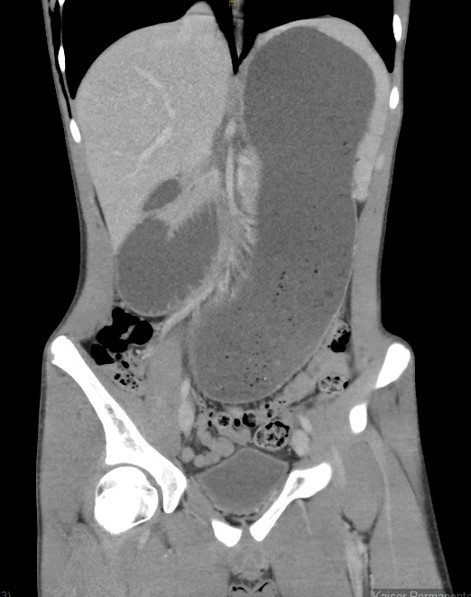 Abramo CT scan downloaded 1.jpg