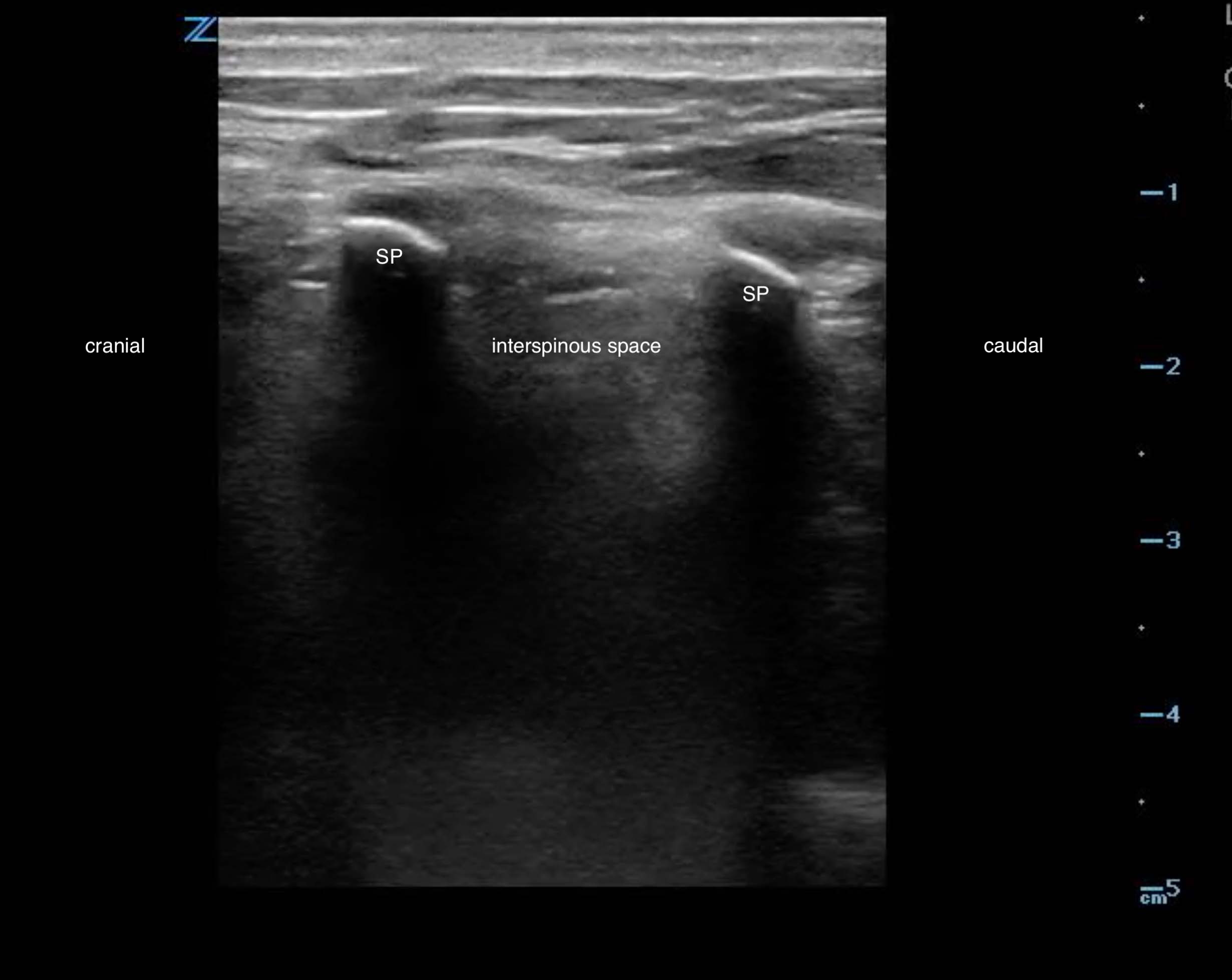 LB Figure 1. Sagittal view spinous processes.jpg