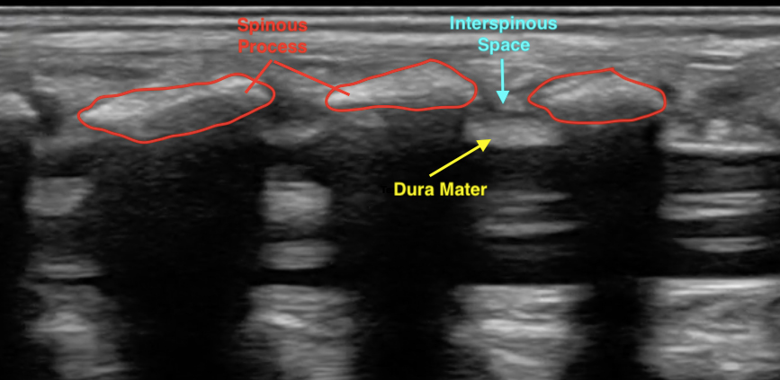 LB Figure 4. Normal spinal anatomy pediatric.jpg