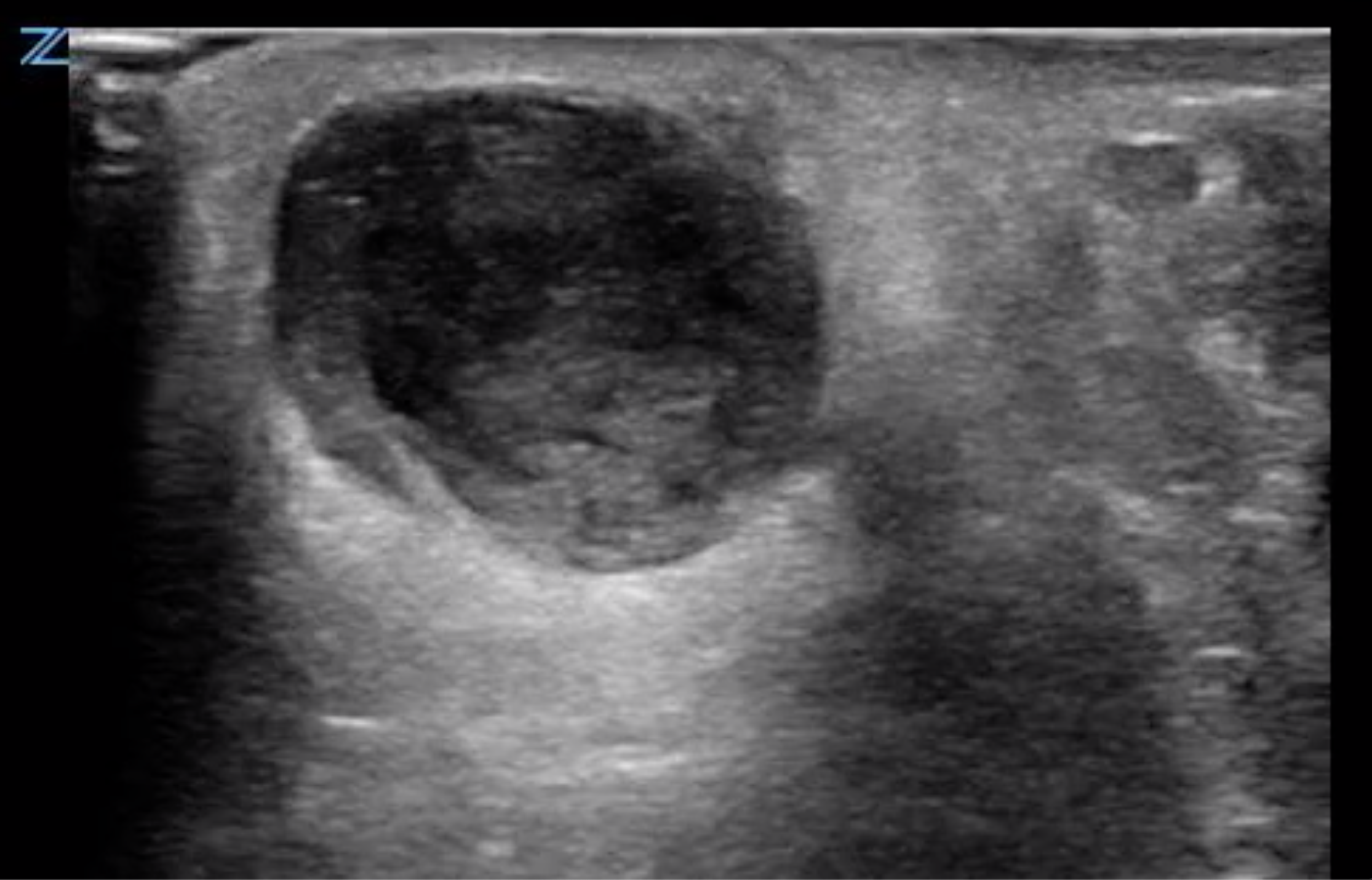 Figure 2- Abscess containing hyperechoic debris.png