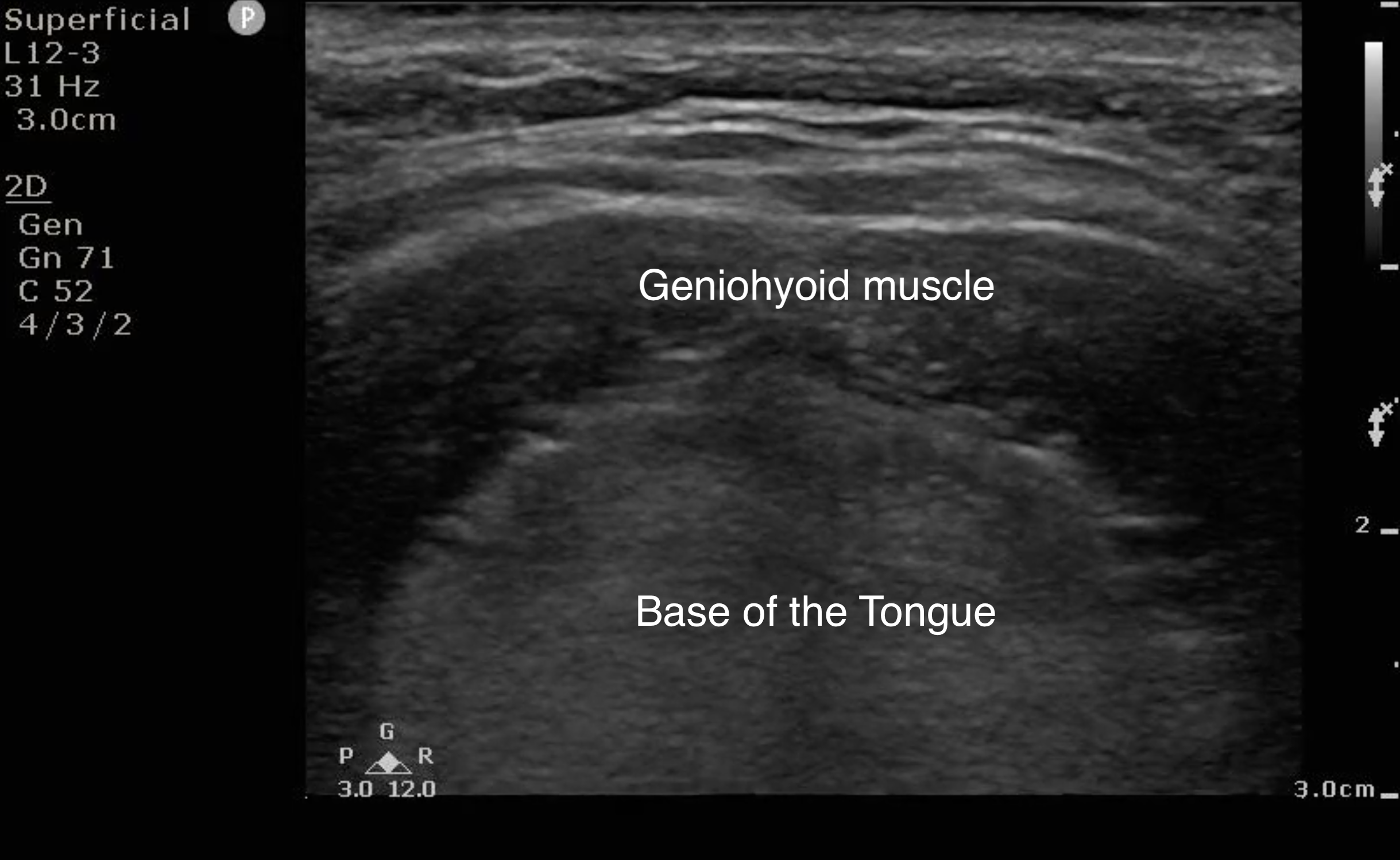 FIG 1a Image Base of the Tongue.png