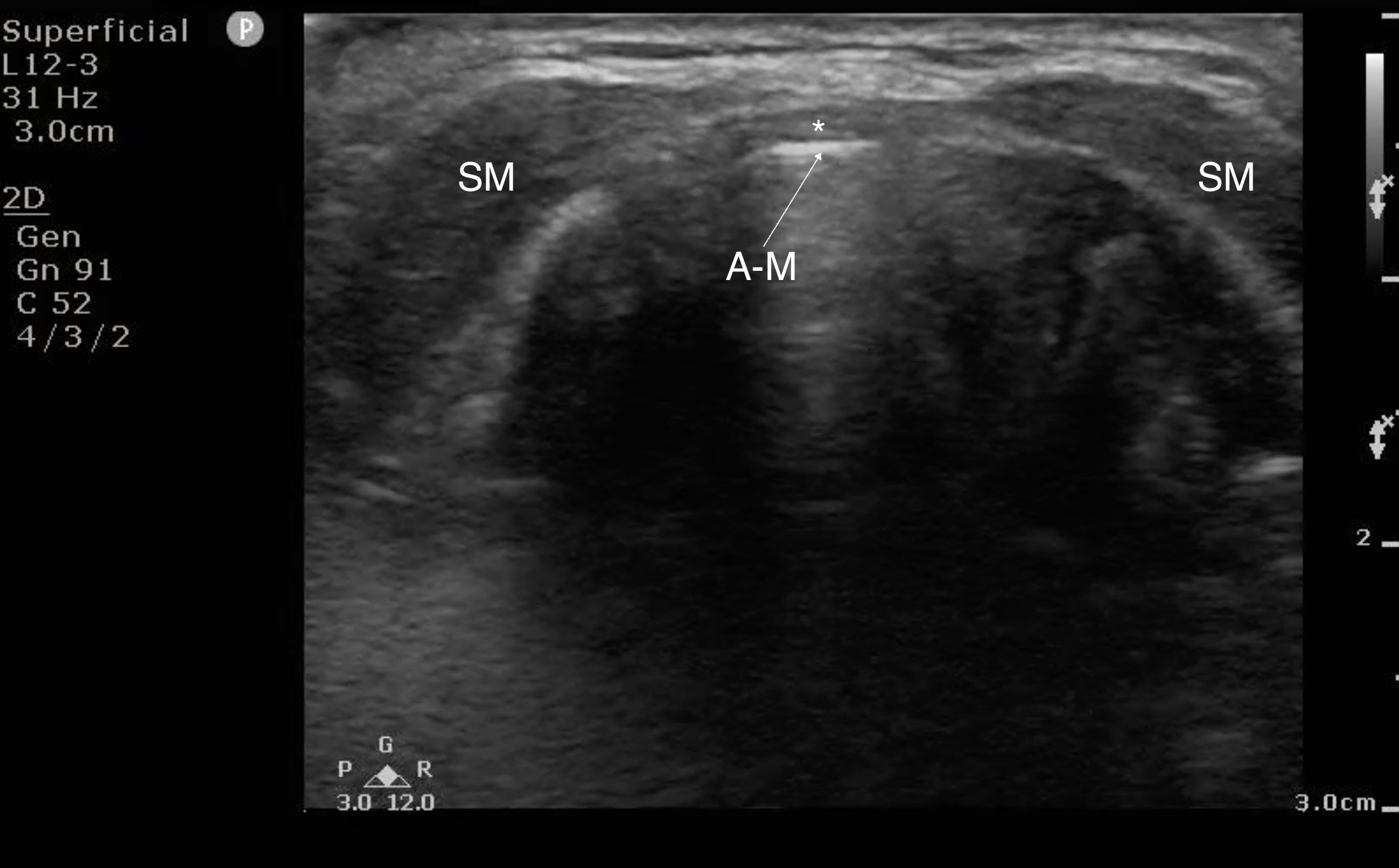 FIG 5a Image Cricothyroid Membrane.png