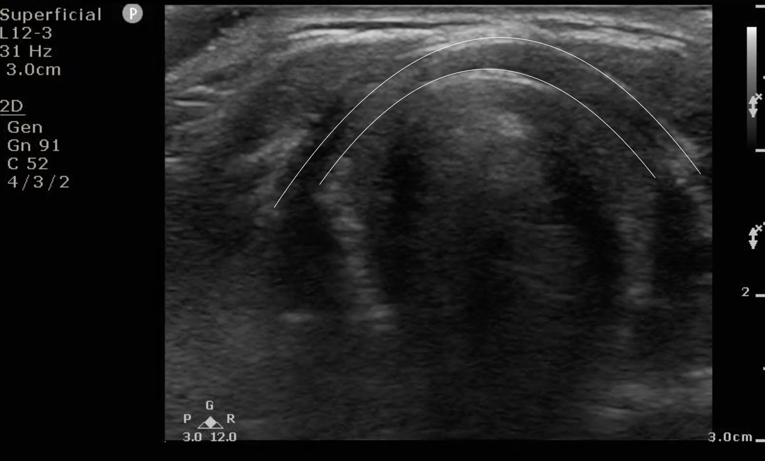 FIG 6a Image Cricoid Cartilage.png