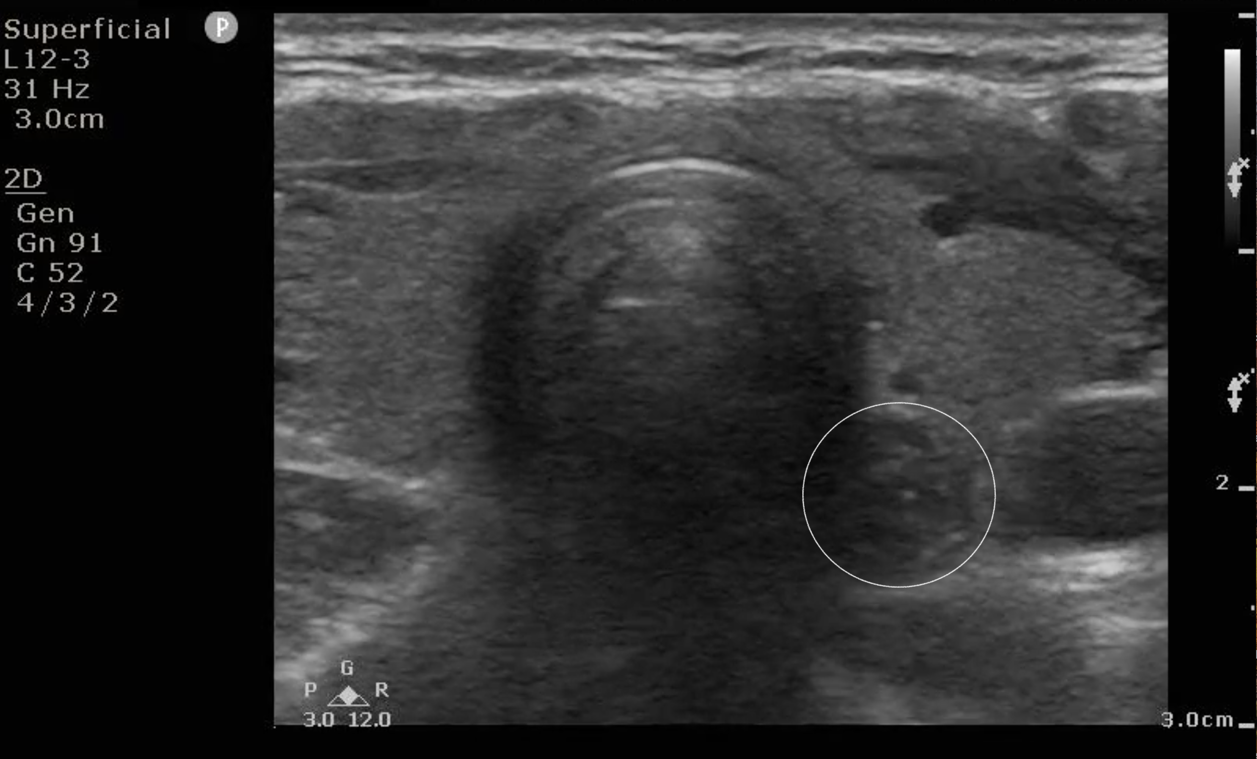 FIG 7a Image Trachea and Esophagus.png