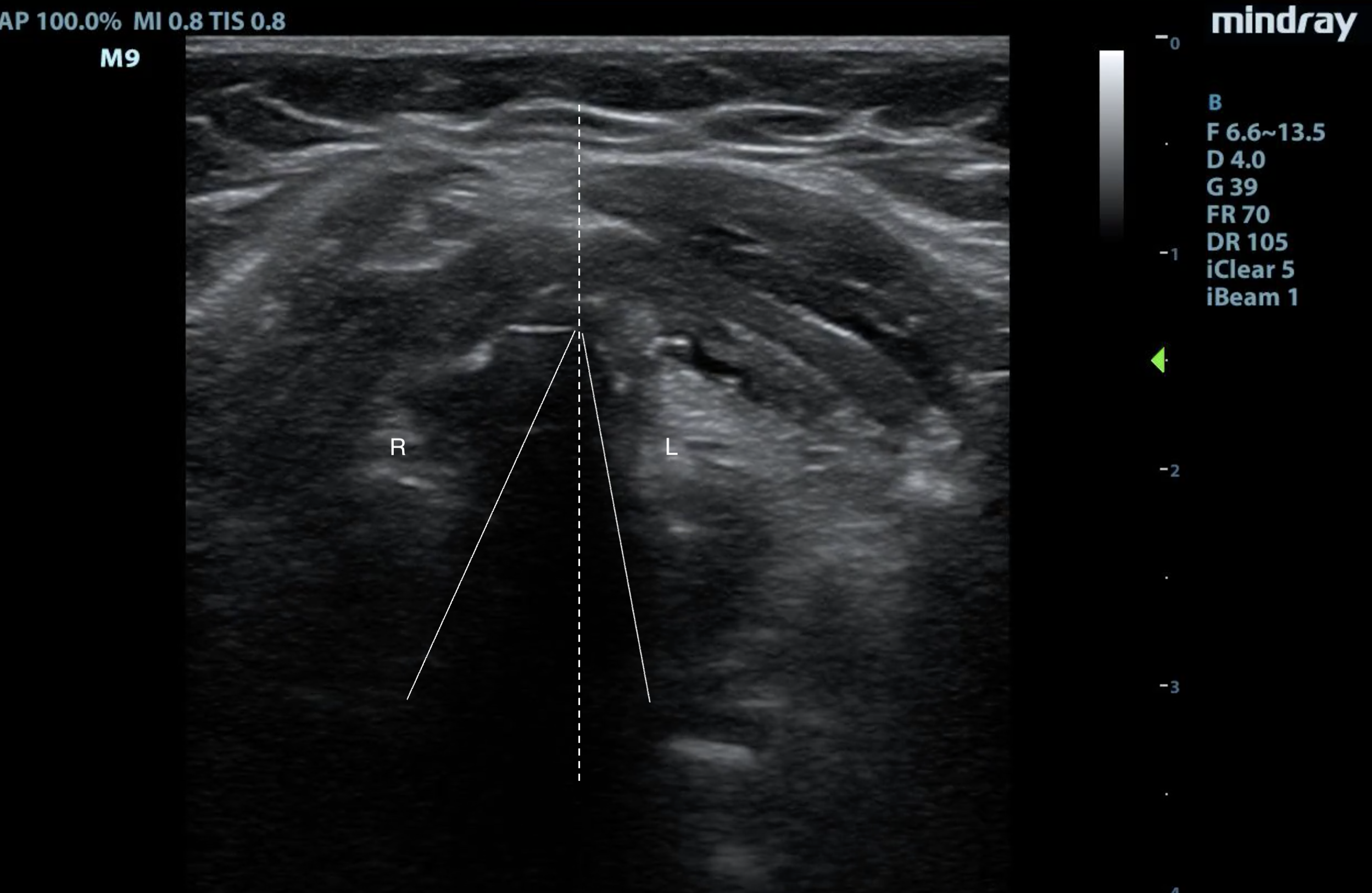 FIG 9 Vocal cord dysfunction.png