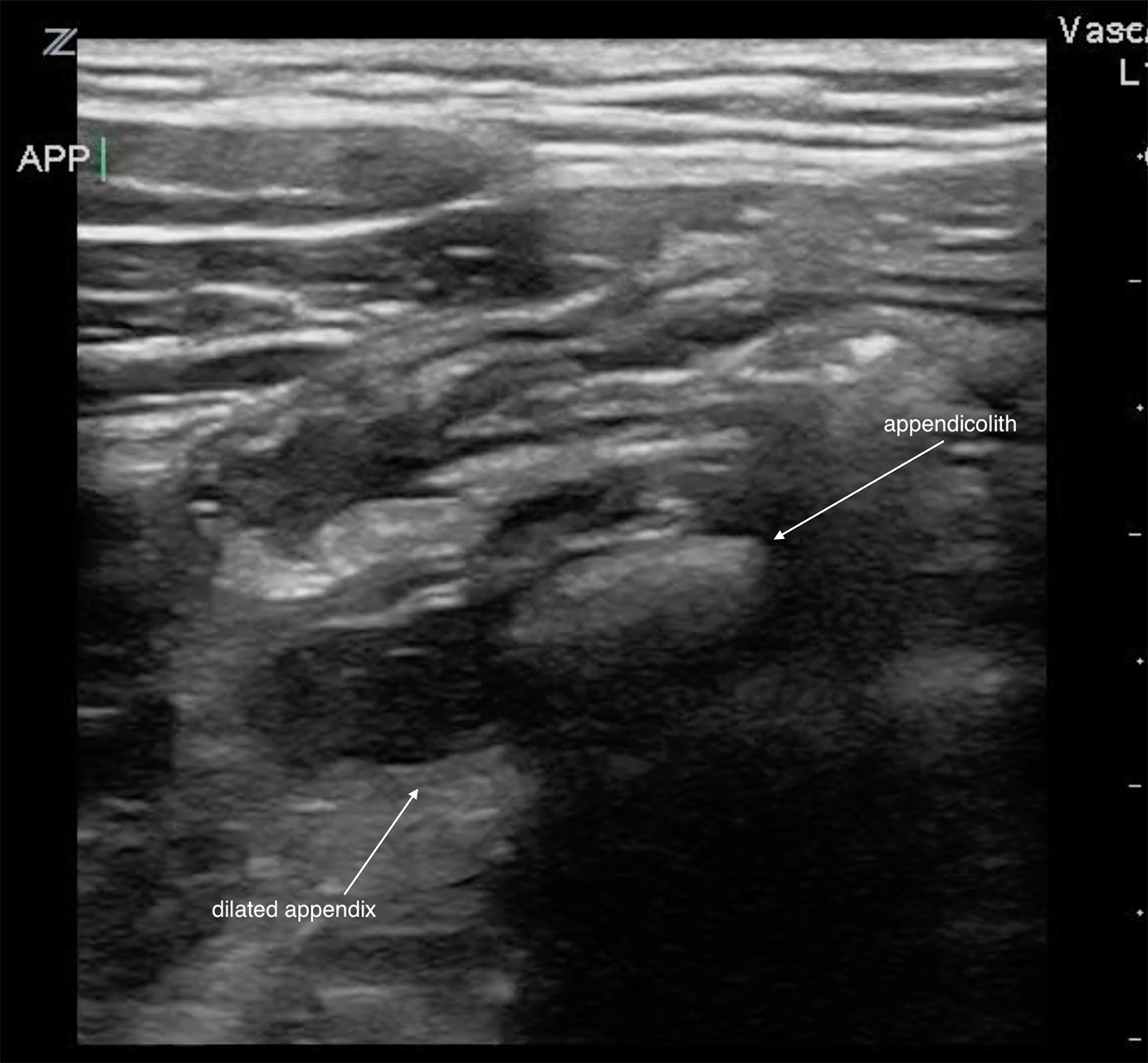Figure 6 - appendicolith.jpg