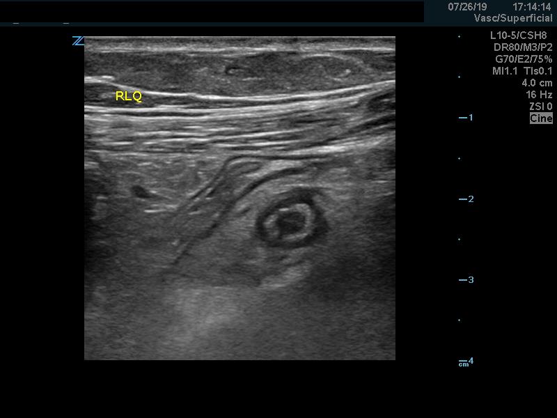 Figure 7 - periappendiceal inflammation.jpg