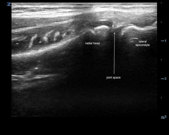 Figure 11 - US demonstrating formal radiohumeral joint space.jpg