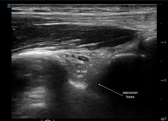 Figure 13 - US image demonstrating normal posterior fat pad.jpg