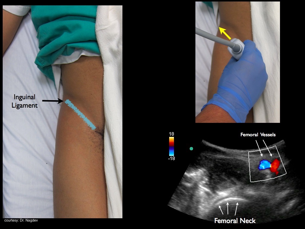 Figure 6 - Transducer placement for hip arthrocentesis.jpeg