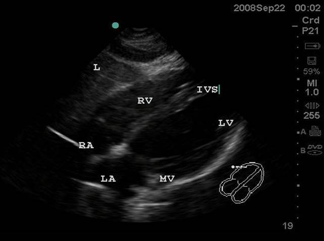 Image 1. Subxiphoid view.jpg