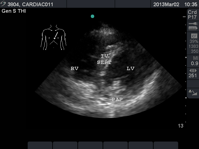 Image 3. Parasternal short axis view.jpg