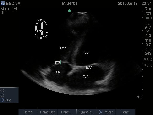 Image 4. Apical Four Chamber View.jpg