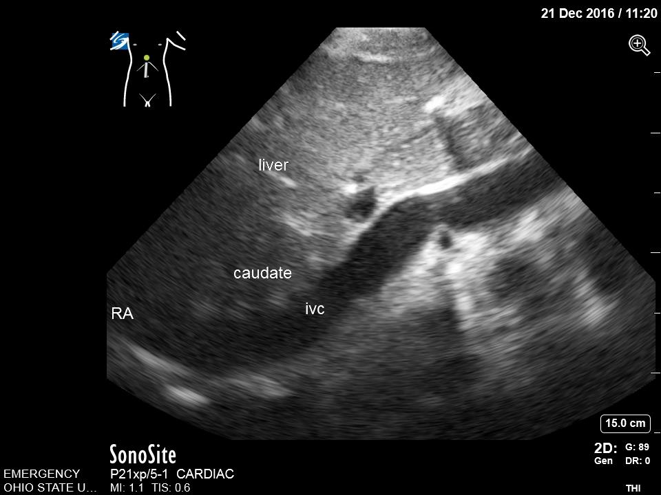 Image 7. Subcostal Inferior Vena Cava in Long Axis.jpg