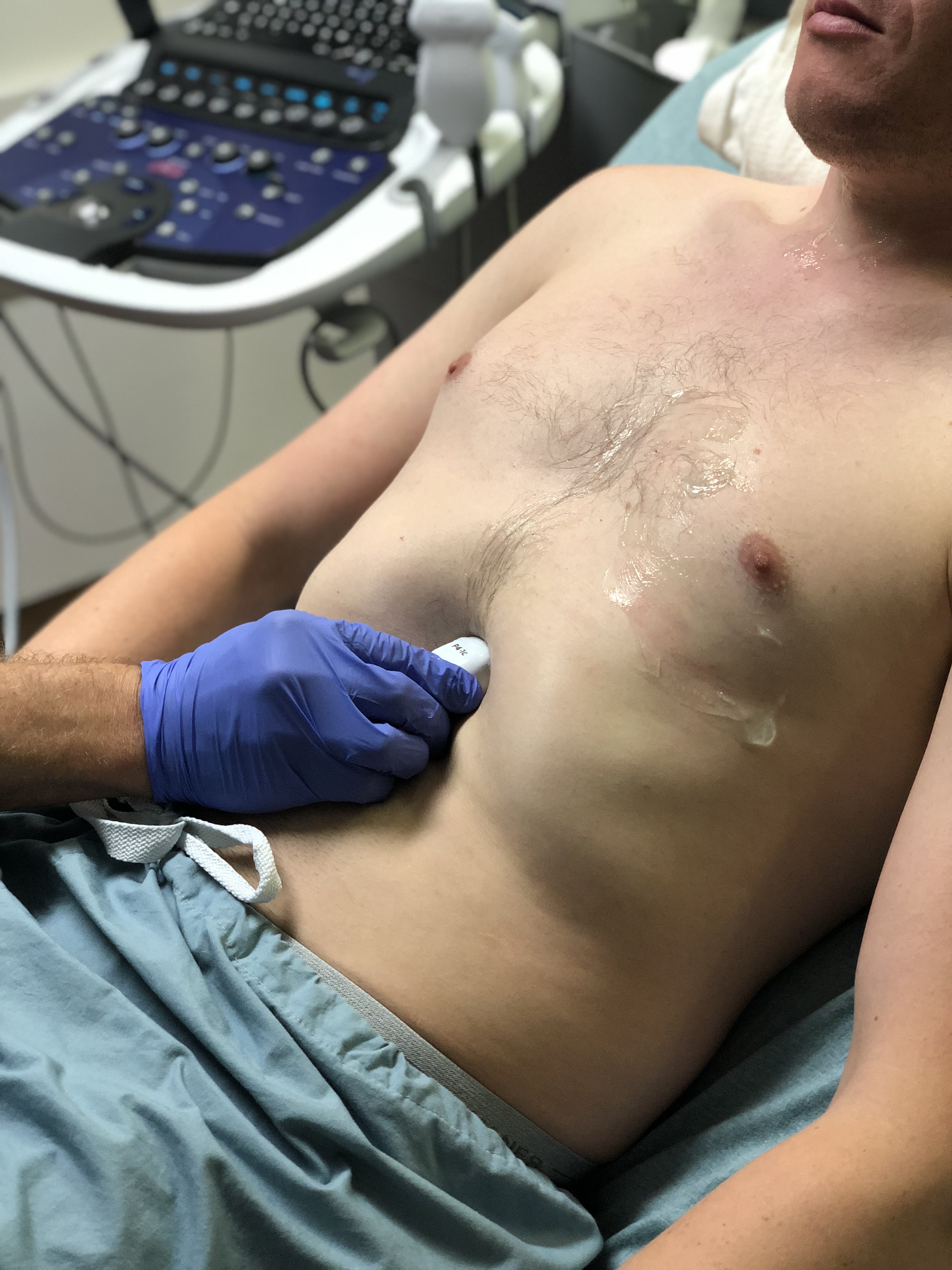 Probe position for acquisition of subxiphoid view.jpg