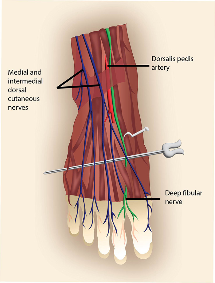 Illustration 2 - part 2 - deep peroneal nerve foot.jpg