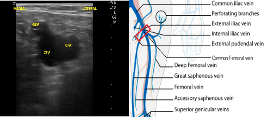 FIgure 10- CFV and GSV anatomy.png