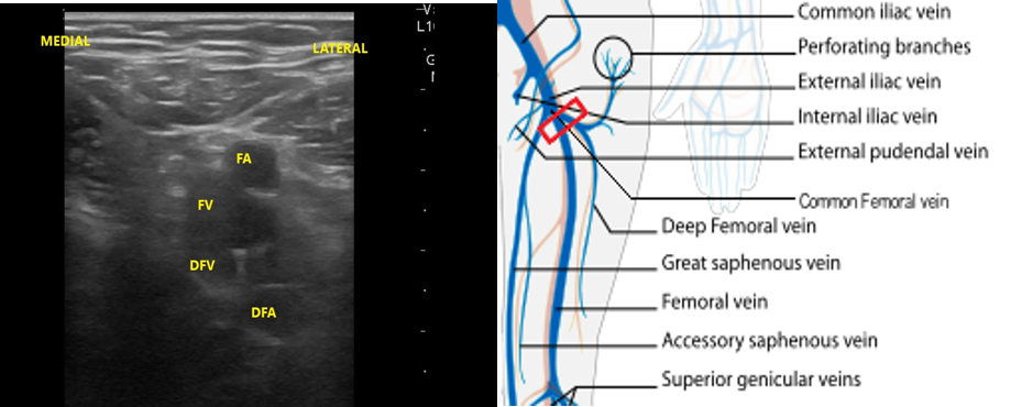 Figure 12- FV DFV anatomy.png