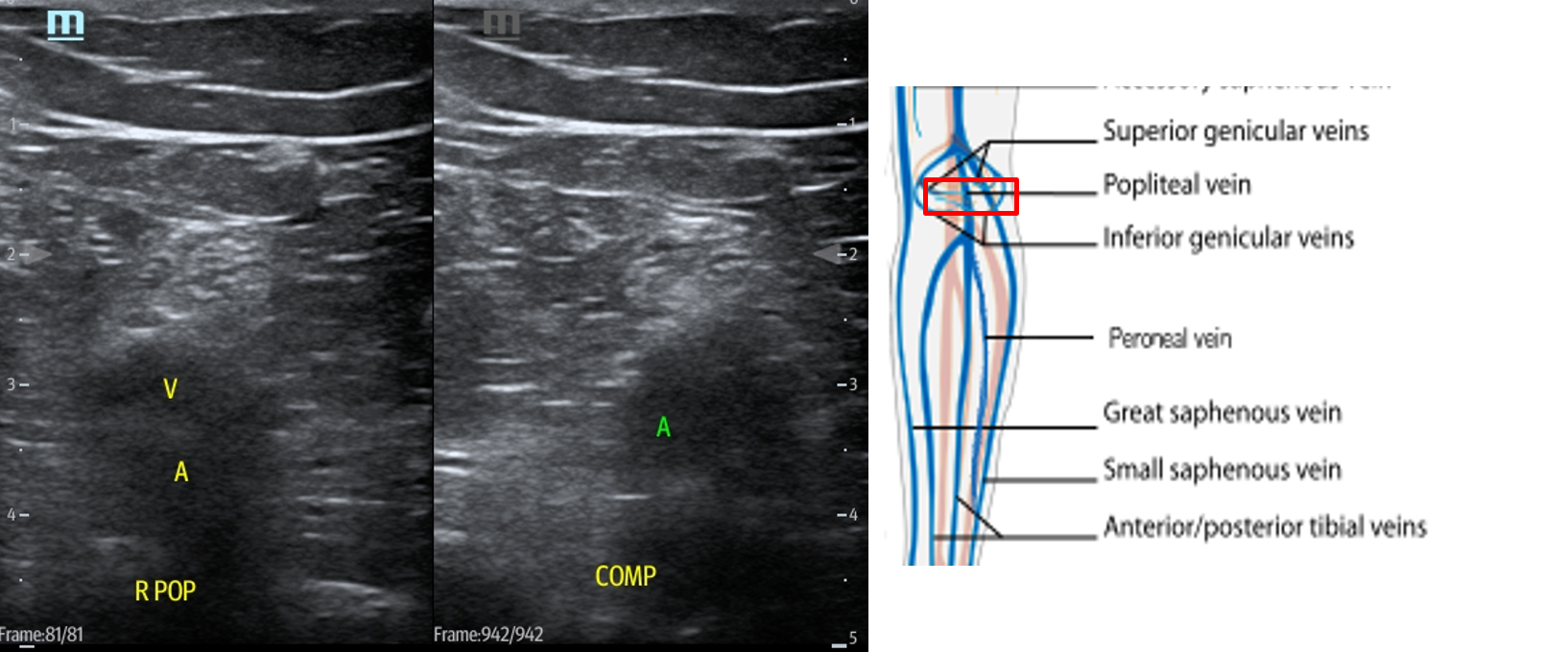 Figure 14 Popliteal vein and artery (3).png