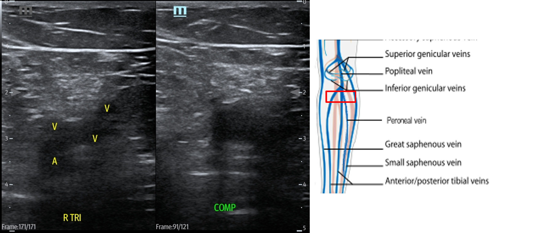 Figure 15 Trifurcation (2).png