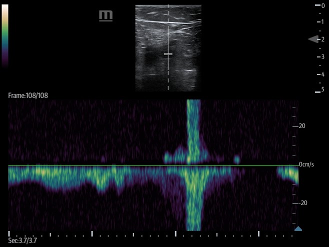 Figure 16. augmentation of calf vein .jpg