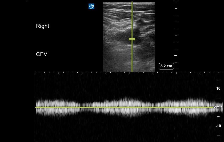 Figure 17. Respiratory variation (phasic flow).jpg