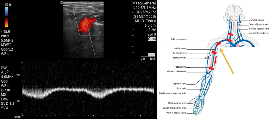Figure 5 SC in Ax with RPV .png