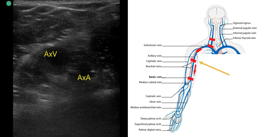 Figure 6 Axillary vein and artery.png