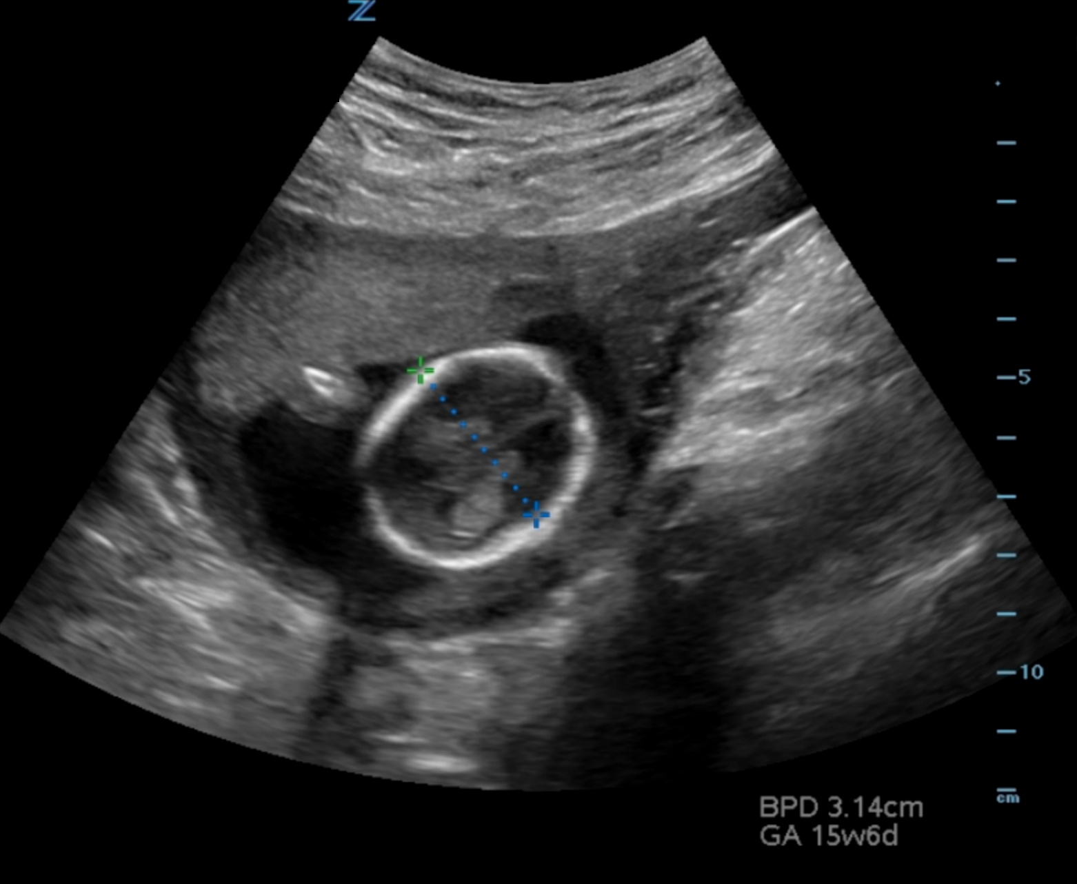 Illustration 11- Biparietal diameter (BPD).png