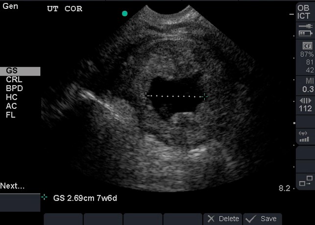 Illustration 15- Involuting gestational sac.jpg