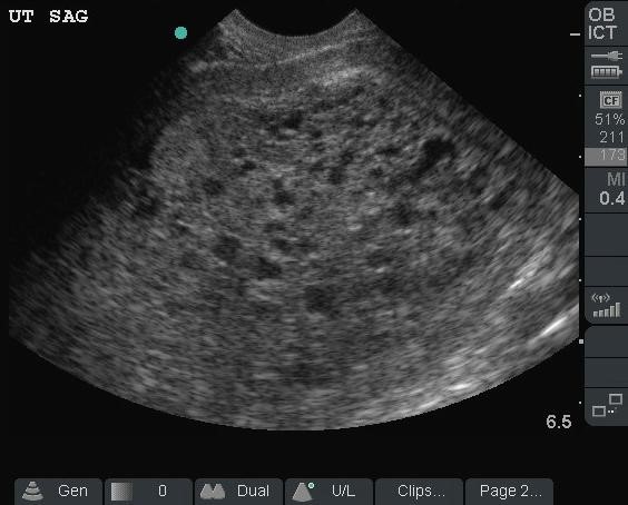 Illustration 19- Molar pregnancy.jpg