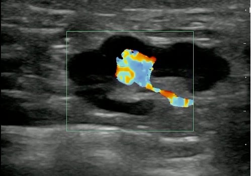 -Figure 13 - Lymph Node with Color Doppler.jpg