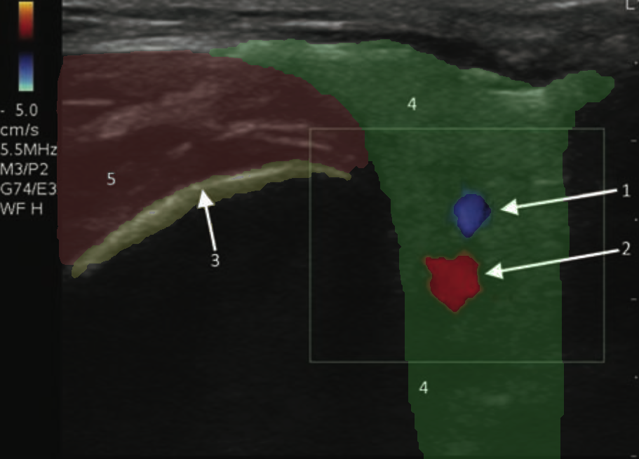 -Figure 16 - Parotid Vessels with Color.png