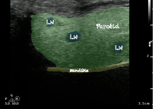 -Figure 20 - Parotid Lymph Nodes with Color.png