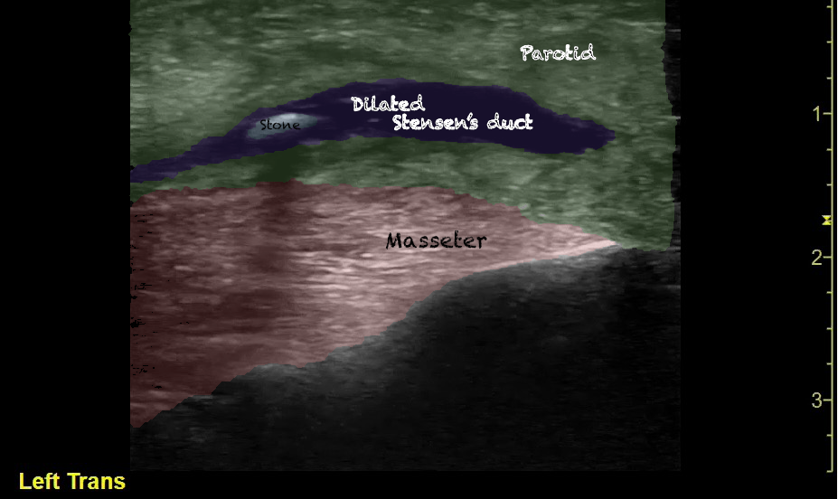 -Figure 24 - Parotitis Sialolithiasis with Color.png