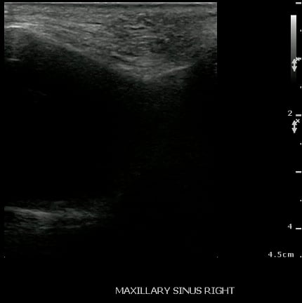 -Figure 29 - Sinusitis.jpg