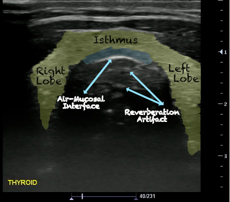 -Figure 32 - Thyroid.png