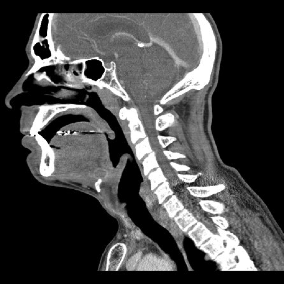 -Figure 36 - Thyroglossal Duct Cyst CT.png