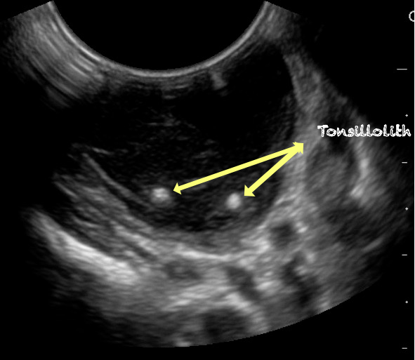 -Figure 44 - Tonsillolith.png